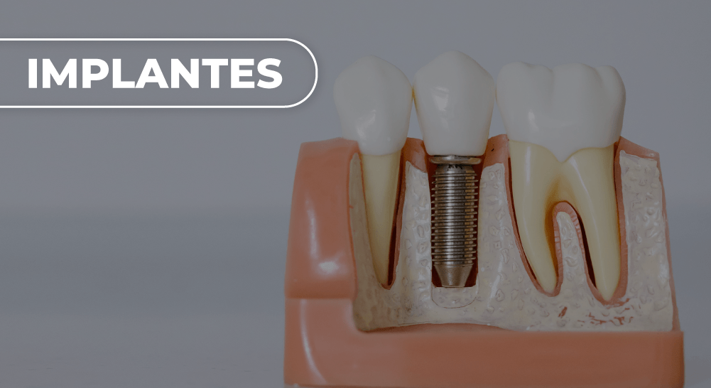 IMPLANTES